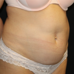 Tummy Tuck Before & After Patient #32133