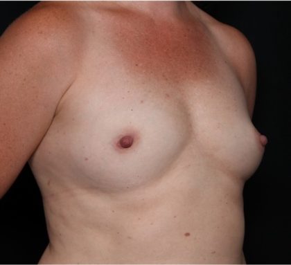 Breast Augmentation - Round Silicone Implants Before & After Patient #31996