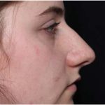 Rhinoplasty Before & After Patient #32049