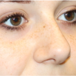 Rhinoplasty Before & After Patient #32144