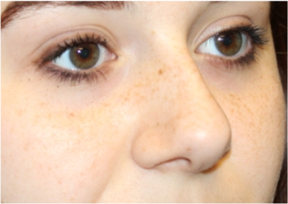 Rhinoplasty Before & After Patient #32144