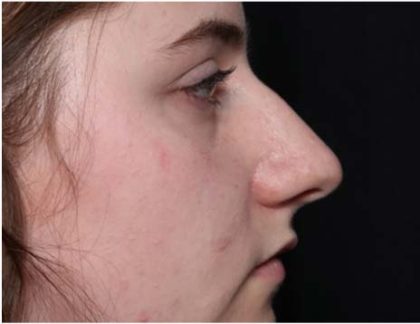 Rhinoplasty Before & After Patient #32049
