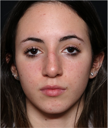 Rhinoplasty Before & After Patient #32157