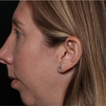 Rhinoplasty Before & After Patient #32113