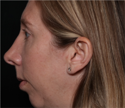 Rhinoplasty Before & After Patient #32113