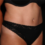 Tummy Tuck Before & After Patient #32133