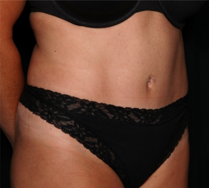 Tummy Tuck Before & After Patient #32133