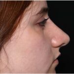 Rhinoplasty Before & After Patient #32049
