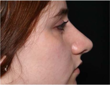 Rhinoplasty Before & After Patient #32049