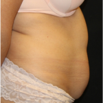 Tummy Tuck Before & After Patient #32133