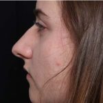 Rhinoplasty Before & After Patient #32049