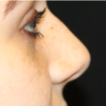 Rhinoplasty Before & After Patient #32144