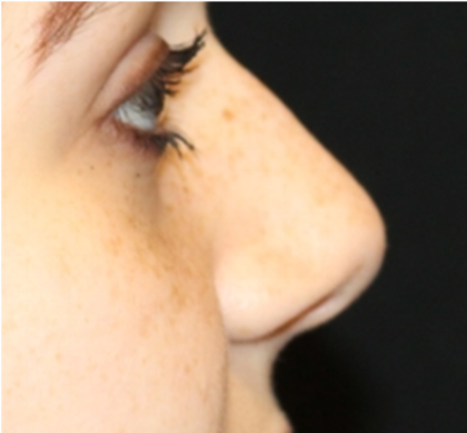 Rhinoplasty Before & After Patient #32144