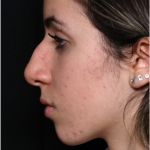 Rhinoplasty Before & After Patient #32157