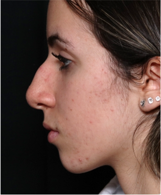 Rhinoplasty Before & After Patient #32157