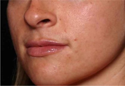 Lip Filler Before & After Patient #32019