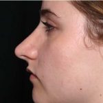 Rhinoplasty Before & After Patient #32049