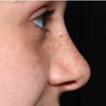 Rhinoplasty Before & After Patient #32144