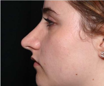 Rhinoplasty Before & After Patient #32049