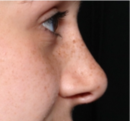 Rhinoplasty Before & After Patient #32144