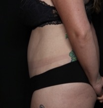 Tummy Tuck Before & After Patient #32087