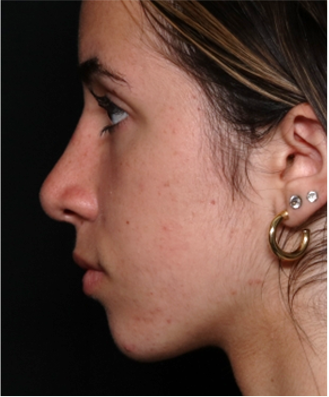 Rhinoplasty Before & After Patient #32157