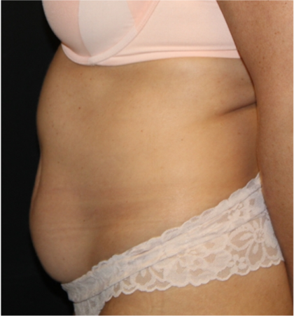 Tummy Tuck Before & After Patient #32133