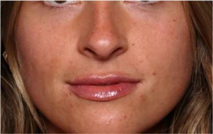 Lip Filler Before & After Patient #32019