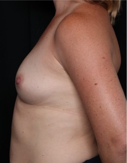 Breast Augmentation - Round Silicone Implants Before & After Patient #31996