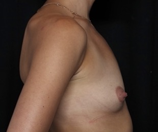 Breast Augmentation Before & After Patient #32168