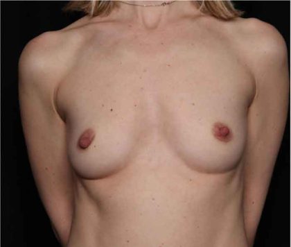 Breast Augmentation - Round Silicone Implants Before & After Patient #32319