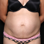 Tummy Tuck Before & After Patient #32234