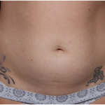 Tummy Tuck Before & After Patient #32243