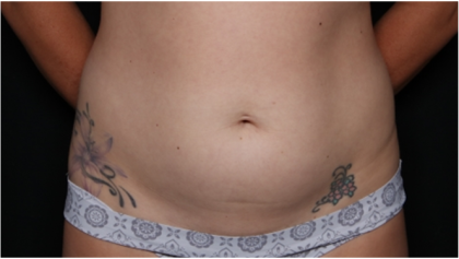 Tummy Tuck Before & After Patient #32243