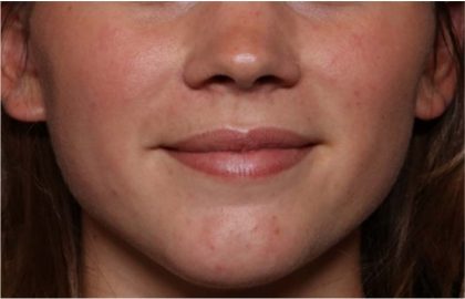 Lip Filler Before & After Patient #32312
