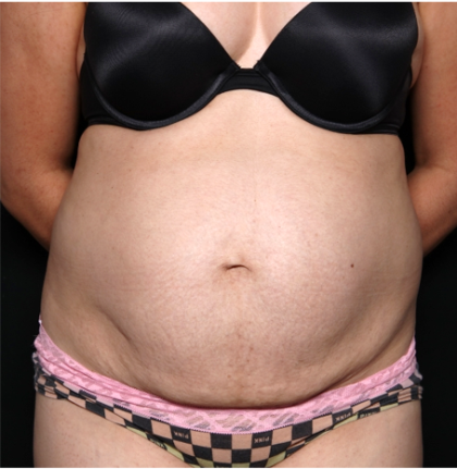 Tummy Tuck Before & After Patient #32234