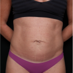 Tummy Tuck Before & After Patient #32301