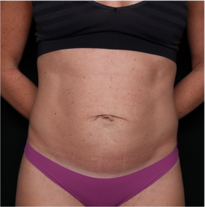 Tummy Tuck Before & After Patient #32301