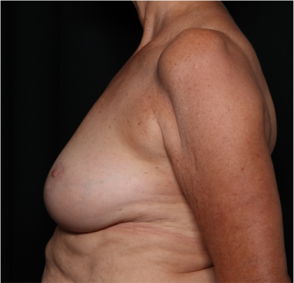 Breast Reduction Before & After Patient #32264