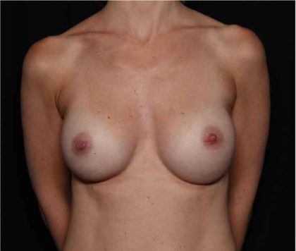 Breast Augmentation - Round Silicone Implants Before & After Patient #32319