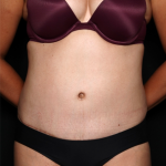 Tummy Tuck Before & After Patient #32234