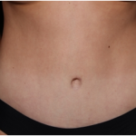 Tummy Tuck Before & After Patient #32243