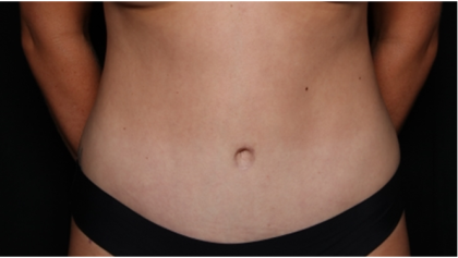 Tummy Tuck Before & After Patient #32243