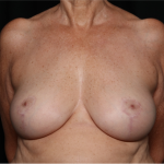 Breast Reduction Before & After Patient #32264