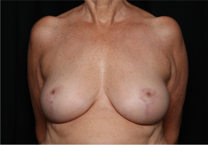 Breast Reduction Before & After Patient #32264