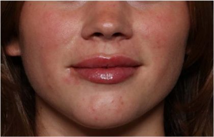 Lip Filler Before & After Patient #32312