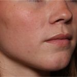 Lip Filler Before & After Patient #32312