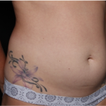 Tummy Tuck Before & After Patient #32243