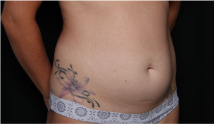 Tummy Tuck Before & After Patient #32243