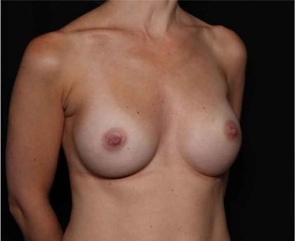 Breast Augmentation - Round Silicone Implants Before & After Patient #32319